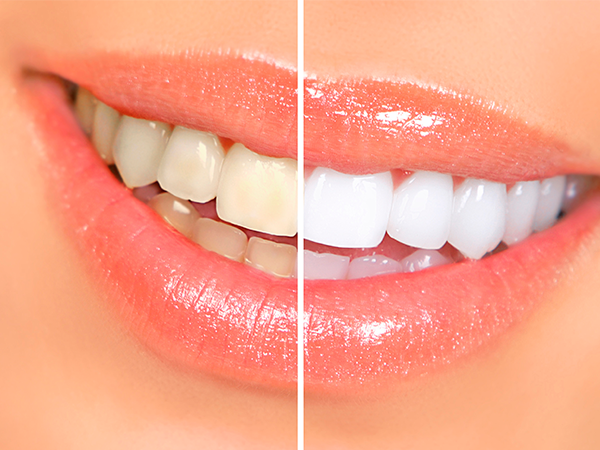 dentalna kozmetika beljenje zob luske veeners